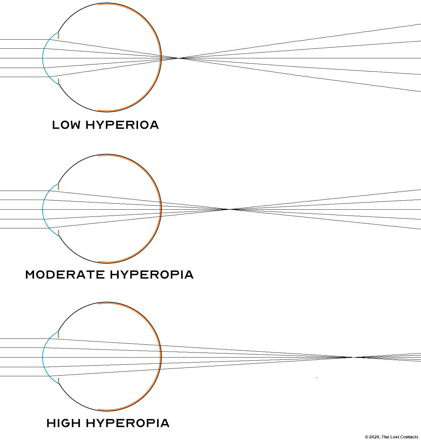 The Optics of Vision Lesson 7 Hyperopia The Lost Contacts